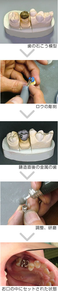 銀歯が作られる過程