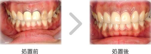 セラミックのホワイトニング例