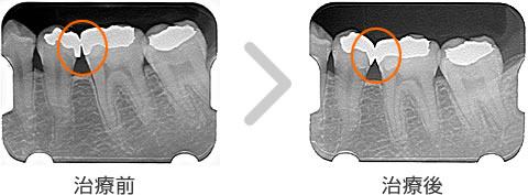 歯と詰め物の関係